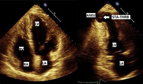 lv apex aneurysm